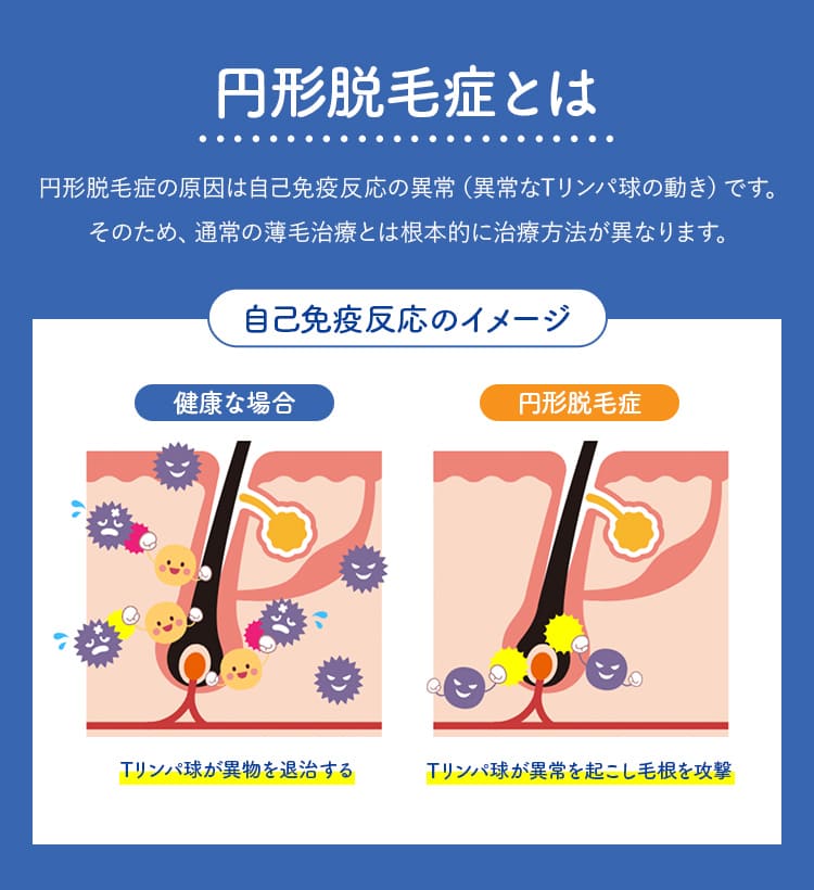 円形脱毛症とは　円形脱毛症の原因は自己免疫反応の異常(異常なTリンパ球の働き)です。そのため、通常の薄毛治療とは根本的に治療方法が異なります
